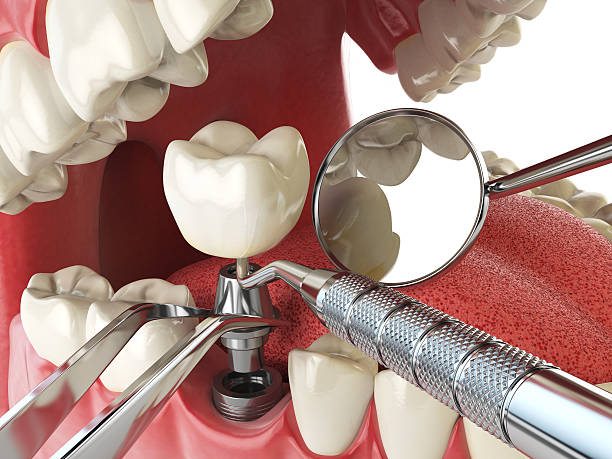Best Emergency Tooth Extraction in Highland Village, TX
